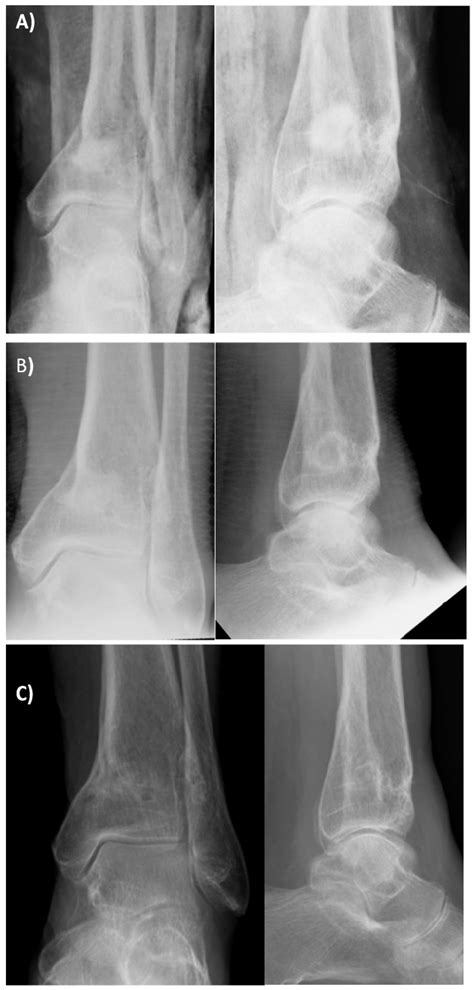 A Immediate Post Operative Follow Up Radiographs Ap And Lateral