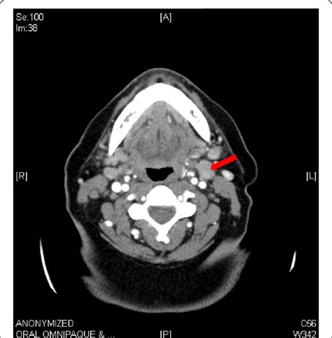 Ct Of Neck Demonstrating Bilateral Diffuse Lymphadenopathy With The