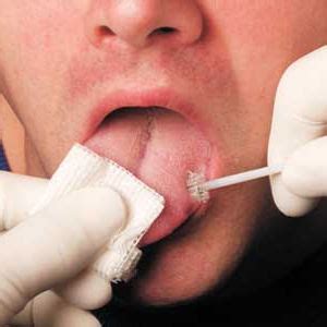 El cepillo sónico ha demostrado mayor eficacia en la limpieza y reducción de placa dental que un cepillo manual. Cepillo de citología bucal - OralCDx® - CDx Diagnostics - de un solo uso