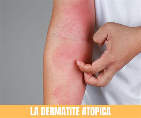 Dermatite Atopica Sintomi Cause E Rimedi The Best Porn Website