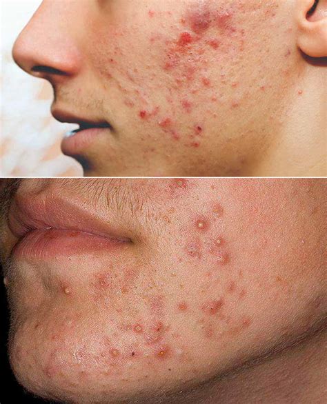 Acne Papulopustulosa Akademija