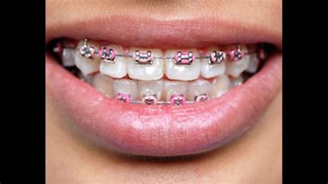 Fake Braces Are The Latest Trend In Asia