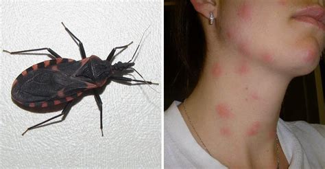 Beware Of “kissing Bugs” They May Sound Cute But They Are Actually