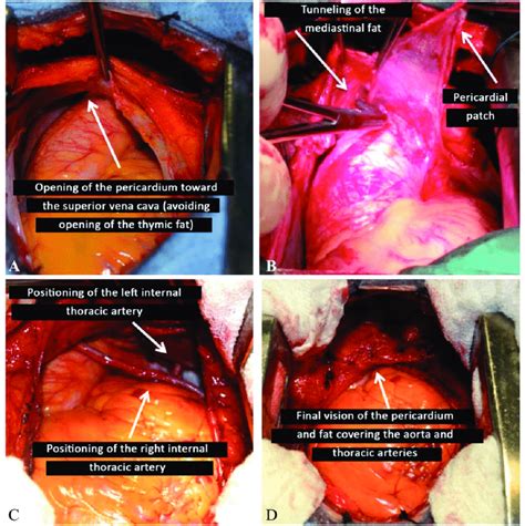 A Surgical Photo Showing The Opening Of The Pericardium Until The