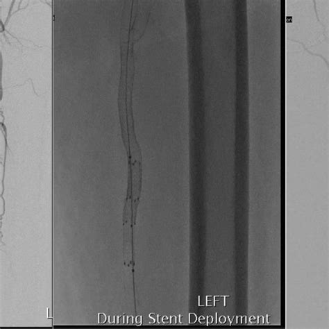 Intra Operative Images Of The Superficial Femoral Artery Before And