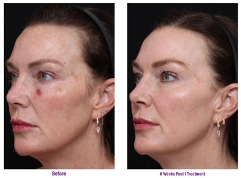 3dultra Deep Facial Rejuvenation Treatment Nyc Dagan Md Facial