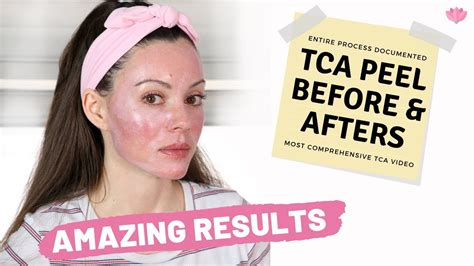 Tca Peel At Home Before And Afters Day By Day Closeups Of Results