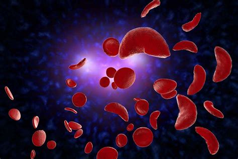 Despite Challenges Treatments For Sickle Cell Disease Are Improving