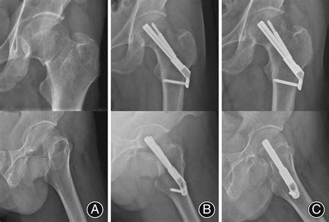 Comparison Of Early Clinical Results For Femoral Neck System And