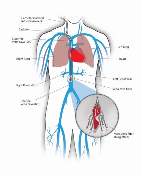 Filtros De Vena Cava Inferior Centro Para El Cuidado De Las Venas Ottima