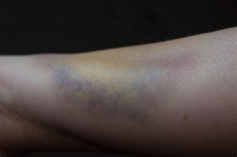 Bruised Arm Photograph By Frank Gaertner Pixels