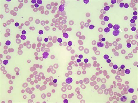 Chronic Lymphocytic Leukemia Cll A Laboratory Guide To Clinical