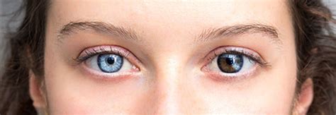 What Causes Heterochromia Tucson Optometry Clinic