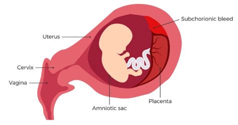 Subchorionic Bleeding Hematoma In Pregnancy Detection And Causes
