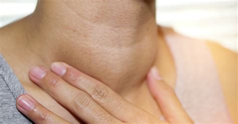 Nódulo Tireoide Grau 3