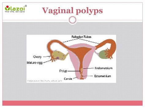 ppt vaginal polyps causes symptoms diagnosis and treatment powerpoint presentation id