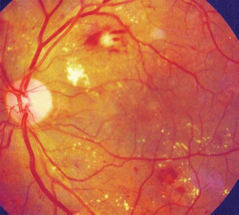 Community Eye Health Journal Diabetic Retinopathy Clinical Findings