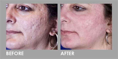 Fractional CO Laser For Large Pore Reduction Premier Clinic