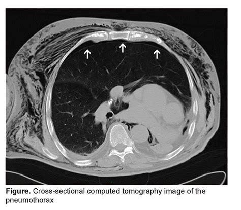 Pneumothorax In A Single Lung Patient The Western Journal Of