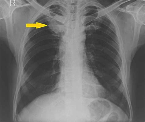 chest xray for diagnosis of lung cancer