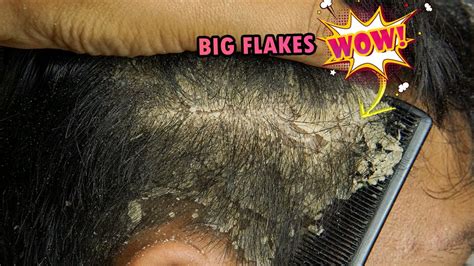 Picking Big Scalp Flakes Psoriasis On Right Side 494 Youtube