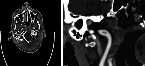 Unusual Case Of Traumatic Cervical Internal Carotid Artery Dissection