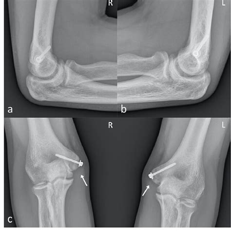 Post Operative Radiographs Of Both Elbows Post Operative Lateral A B