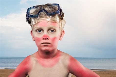Sunburnt Images Pictures In  Hd Free Stock Photos