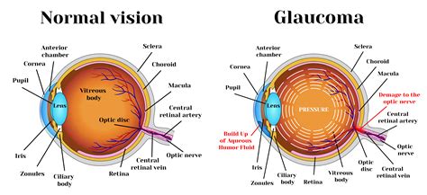 What Is Glaucoma Learn About Glaucoma Glaucoma Resources