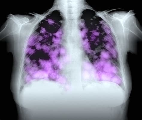 Secondary Lung Cancers X Ray Photograph By Du Cane Medical Imaging Ltd