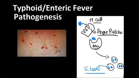 Pathogenesis Of Typhoid Fever Enteric Fever Youtube