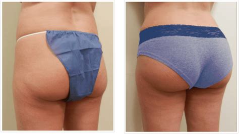 Brazilian Butt Lift Chicago Fat Transfer Butt Enhancement Dr Wiener