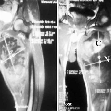 Mri Of A Case Of Liposarcoma In The Upper Posterior Aspect Of The Leg