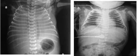 Chemical Pleurodesis With Oxytetracycline In Congenital Chylothorax