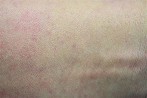 Photo Libre De Droit De Malade Dermatite Éruption Allergique De La Peau