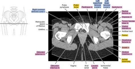 Ct Of The Female Pelvis Radiology Key