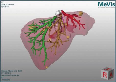 The coronary ligament, the left and right triangular ligaments, and the falciform ligament. Planning data (as obtained from MeVis) depicting the 3D liver model as... | Download Scientific ...