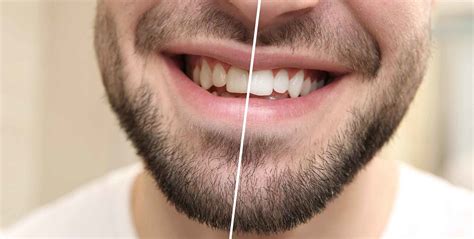 tooth whitening 101 part four dentistry online