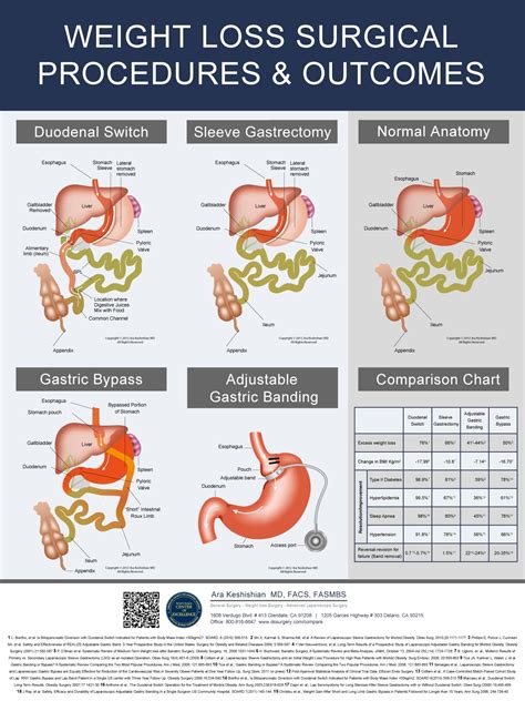 outcomes comparison chart for surgical weight loss procedures dssurgery