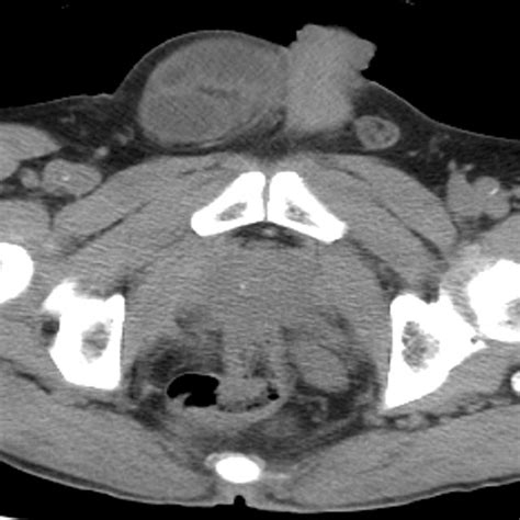 Ct Image Of A Patient With A Right Incarcerated Inguinal Hernia