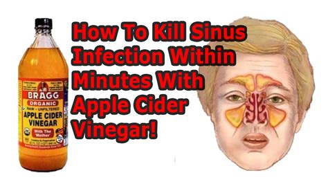 People who have a permanent problem of cold may consult with a doctor. How To Kill Sinus Infection Within Minutes With Apple ...