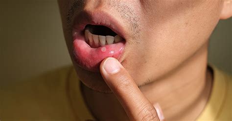 Lupus And Mouth Sores Oral Complications Hss