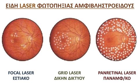 Laser Photocoagulation Eye Day Clinic