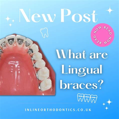 What Are Lingual Braces