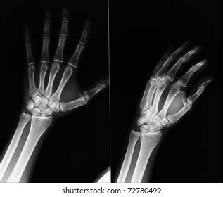 Xray Show Fracture Middle Finger Left Foto De Stock Editar Ahora