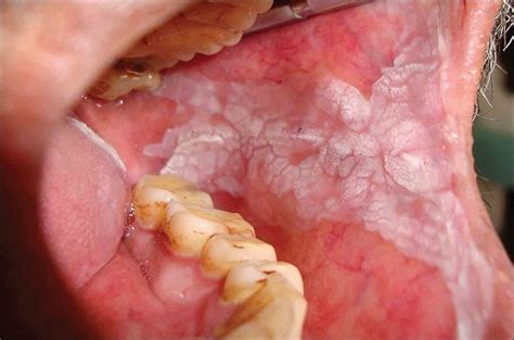White Patches In Mouth Causes And Treatments New Health Advisor