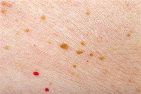 Seriously 35 Facts About Cherry Angioma Pictures You Can Also Find