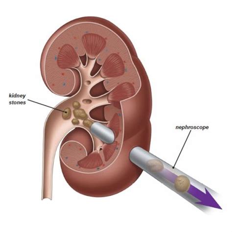 The kidneys are responsible for removing urea and excess minerals from the blood. Retrograde Intrarenal Surgery (RIRS) - Kidney Stones ...