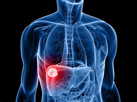 The Main Causes And Symptoms Of Liver Cancer Activebeat