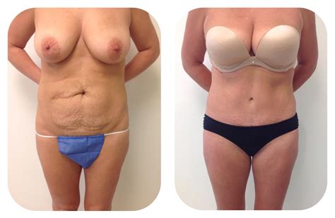 Tummy Tuck 360 Before And After Pictures Case 20 Barrington Illinois